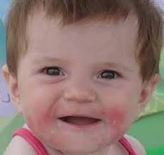 Atopic dermatitis: More than just a rash