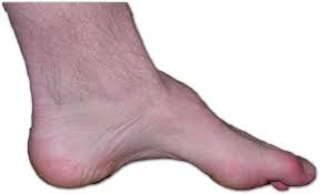 Charcot Marie Tooth Disease Wikipedia