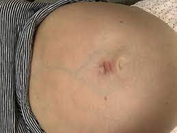 Irritated Belly Piercing Scar January 2020 Birth Club Babycenter Australia