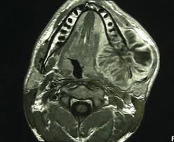 Theres several different types of sarcoma and each type begins in a different kind of bone tissue. Osteosarcoma Of The Jaw Classification Diagnosis And Treatment Intechopen