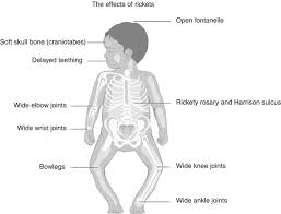 Image result for Craniotabes