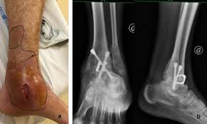 Gestes et postures de manutention. Multidisciplinary Management Of The Bone And Joint Infection Complicating Treatment Of An Open Fracture Of The Lower Limb Sciencedirect