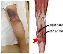 ◯◯を歩くだけでも肉離れは起こる？｜大阪市北浜・守口市の整骨院ならA.T.長島治療院へ