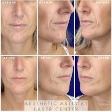 At your consultation, a dermatologist will share their portfolio of work with. Annapolis Juvederm Dermal Fillers Age Gracefully Wrinkle Free