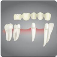 Protese Dentaria Fixa Dentistica Restauradora Clinica De Implantes