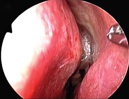 A nasal polyp is a benign (noncancerous) tumor that grows from the lining of the nose or sinuses. Https Www Jpis Org Synapse Data Pdfdata 1150jpis Jpis 49 346 Pdf