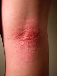 Image result for allergy rash on the legs