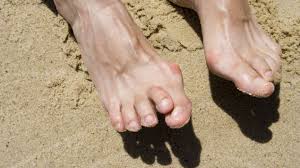 Hallux Valgus Was Hilft Wenn Die Schuhe Drucken Onmeda De