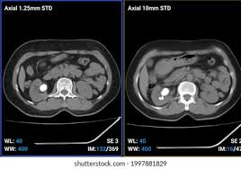 Image result for Nephrolithiasis Imaging