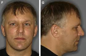 Management of Frontal Sinus Fractures