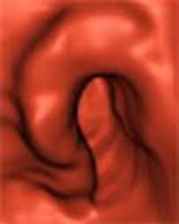 Image result for Virtual Colonoscopy