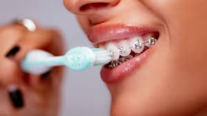 Check spelling or type a new query. Life With Braces Robbinsville Orthodontics