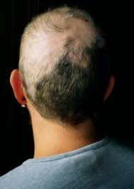 The materials used in a hat—the dyes or textiles, for example—could also play into hair loss, says dr. Trichotillomania Wikipedia