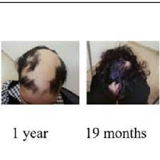 Burning, itching, and pain in hairy areas, or pus at the root of the hair. Pdf Hair Regrowth Following Topical Hairuptm Treatment In Subjects With Alopecia Totalis At And Alopecia Universalis Au A Retrospective Analysis Of Efficacy And Cosmetic Acceptability