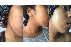 Does Cosrx Triple C Lightning Liquid Fade Hyperpigmentation