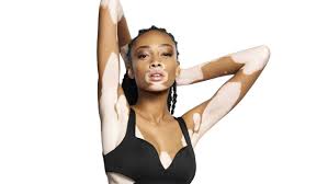 Model With Vitiligo Only You Can Make Yourself Feel Beautiful Vitiligo Model Vitiligo Treatment Vitiligo Cure