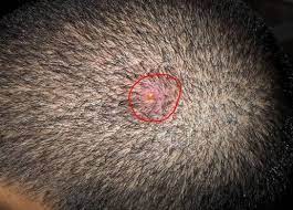 Sometimes when one of these grains rubs loose and i hold it between two fingers i see anyway, i went to the doctor four years ago and they said i have female patter hair loss. How Do You Get Rid Of Scalp Pimples What Causes Them And How Are They Treated Pimples On Scalp Can Be Acne Folliculitis Pimples On Scalp Scalp Bumps Pimples