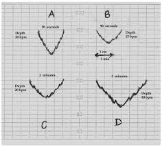 Image result for Early Deceleration