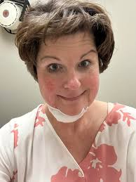 Inspire device for sleep apnea side effects