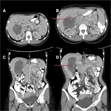 International classification of ultrasound images in cystic echinococcosis for application in clinical and field mechanical suction through wide bore catheters for nonsurgical management of gharbi type iii hepatic hydatid cysts. Biliary Mucinous Cystic Neoplasm Mimicking A Hydatid Cyst A Case Report And Literature Review Bmc Gastroenterology Full Text