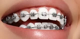 Brushing with braces in this video, i will answer the question of how to brush properly with braces? disclaimer: Going Back To School With Braces 5 Metal Mouth Myths You Can Bust Right Now
