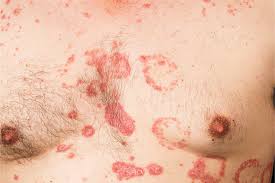Image result for koebner phenomenon psoriasis