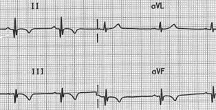 Image result for Q Wave
