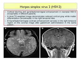 Louis encephalitis virus usually causes encephalitis in healthy individuals in neurodiagnostic evaluation, demonstration of temporal lobe edema and /or bleeding with magnetic resonance imaging (mri) is supportive for diagnosis. Imaging Of Viral Encephalitis