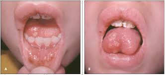 Herpes simplex virus infections may be caused by two virus genotypes: Herpetic Lesions Primary Herpetic Stomatitis Herpetic Whitlow Recurrent Herpes In Uncharacteristic Locations Consultant360