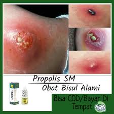 Namun, mencukur bulu kemaluan membuat wanita lebih berisiko terkena penyakit menular seksual. Obat Herbal Bisul Alami Obat Benjolan Bernanah Obat Bisul Di Tangan Dan Kaki Obat Bisul Di Wajah Obat Bisul Di Pantat Obat Bisul Di Payudara Obat Bisul Di Kemaluan Obat Herbal Propolis Sm Original Lazada Indonesia