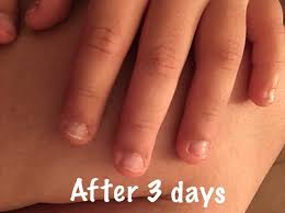 As long as the nail bed remains intact, nail biting isn't likely to interfere with fingernail growth. This Miracle Polish Just Might Get You To Stop Biting Your Nails