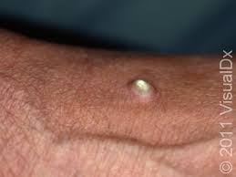 Image result for cornu cutaneum)