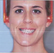 December 26 2012 Pre Op Double Jaw Surgery Jaw Surgery Corrective Jaw Surgery