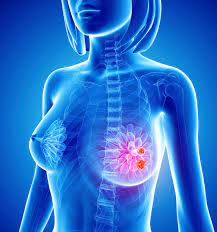 The objective of this study is to evaluate the role of shoulder bursitis as a cause of breast/chest pain. Is The Breast Pain Symptom Of Breast Cancer