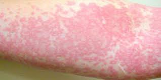 Maybe you would like to learn more about one of these? Hot Tub Rash Prevention Chlorine Bromine Hot Tub Rash Prevention