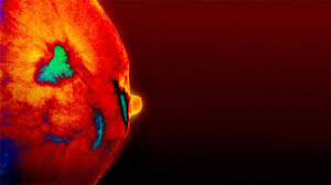 About 80% of breast cancer cases are hormone receptor positive, meaning that these cancer cells need estrogen or progesterone to grow, according to the american cancer society. Roche About Breast Cancer