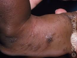Image result for human scabies