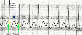 10 Tips To Never Miss Atrial Flutter With 2 1 Conduction Atrial Flutter Flutter Conduction