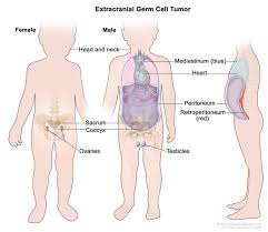 Pylori is believed to be one of the major causes of stomach cancer because it can cause chronic inflammation in your stomach lining, as well as ulcers. Germ Cell Tumors Extracranial University Hospitals