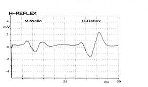 Hoffmann's sign or reflex | upper motor neuron lesion. Https Refubium Fu Berlin De Bitstream Handle Fub188 5530 2 Kap 02 Pdf Sequence 3 Isallowed Y
