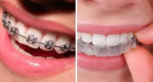 People often wonder how long does invisalign take to invisalign works more quickly. Dental Braces Teeth Braces Cost Procedure Types