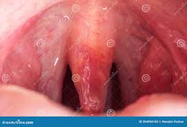 Image result for Uvulitis