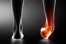This can lead to pain, stiffness, and loss of motion. What To Do When Your Ankles Give Way