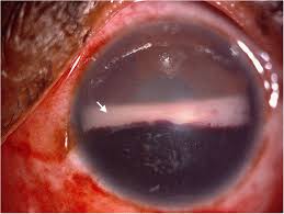 Image result for Hyphema