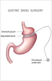Upper Gi Clinic Is Covered Lower Esophagus Stomach And Duodenum Our Specialists Gastric Clinic Bypass To Treat Obesity Relate Clinic Gastric Band Mississauga