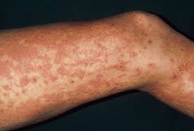 Most individual hives last no more than 24 hours. Gallery Of Hives Pictures For Identifying Rashes