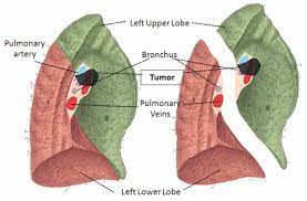 Most lung nodules are benign (not cancerous). Operation For Preservation Of Lung Parenchyma In Central Lung Cancer In Vivo And Ex Situ Reimplantation Techniques Anticancer Research