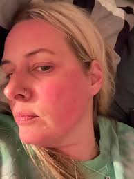 Slightly off topic query😄 Looking for recommended make up to cover post  gluten red face! I have coeliac and normally fine with managing it but have  a family wedding approaching. The last