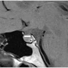 Yoga For Pituitary Gland Activation | Increase Your Height With Yoga