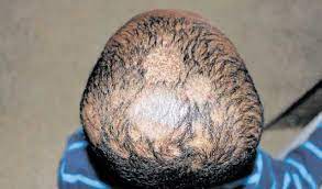 Scalp ringworm is a skin fungus that is called dermatophytes, and this is spread by being around someone else with this infection, and that can include pets with ringworm. When Ringworm Of The Scalp Causes Hair Loss In Your Child The Citizen